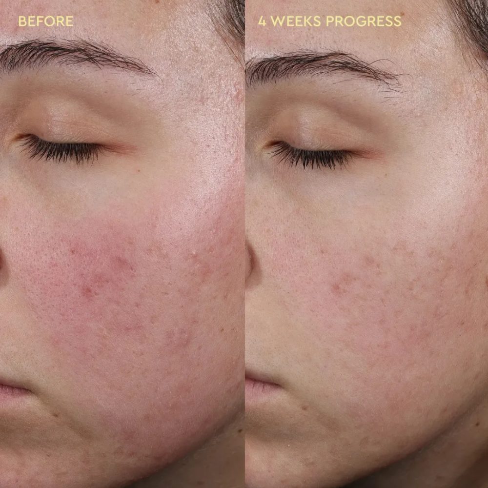 BYOMA Blemish Control Moisturizer