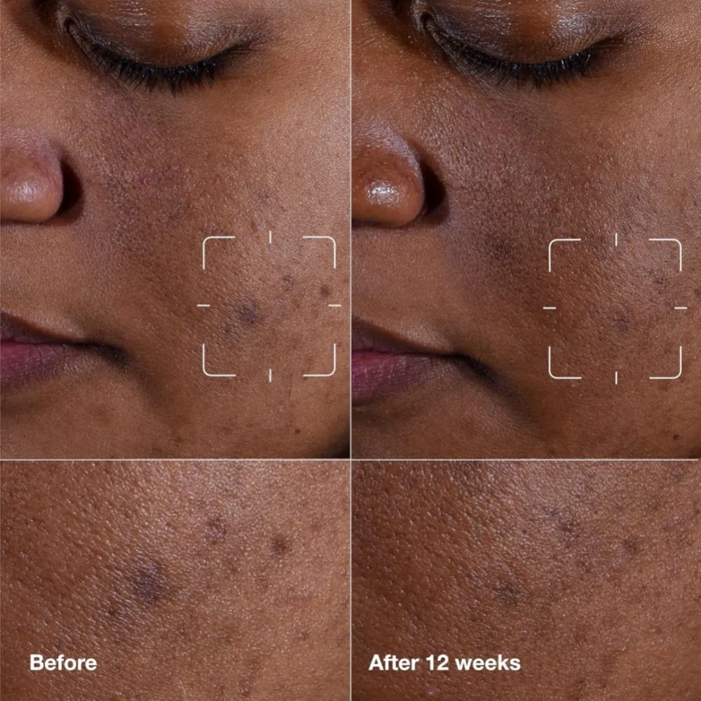 Clinique Even Better Clinical™ Dark Spot Clearing Serum